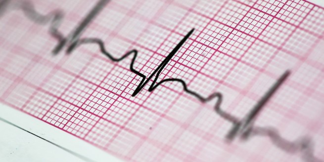 Basic ECG Interpretation image