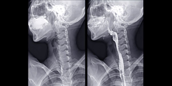 Making the Most of the Modified Barium Swallow image